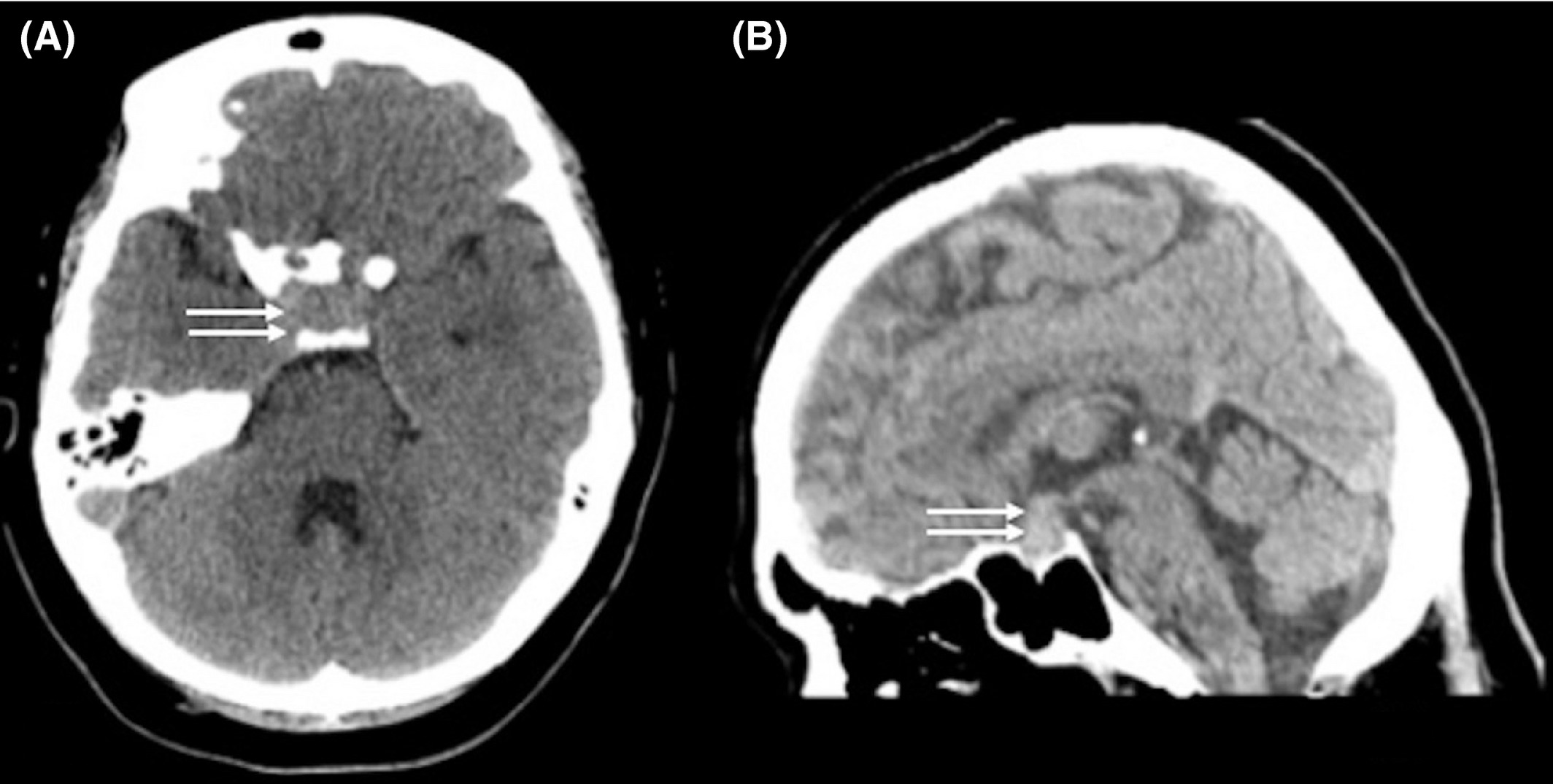 40-facts-about-granulomatous-hypophysitis