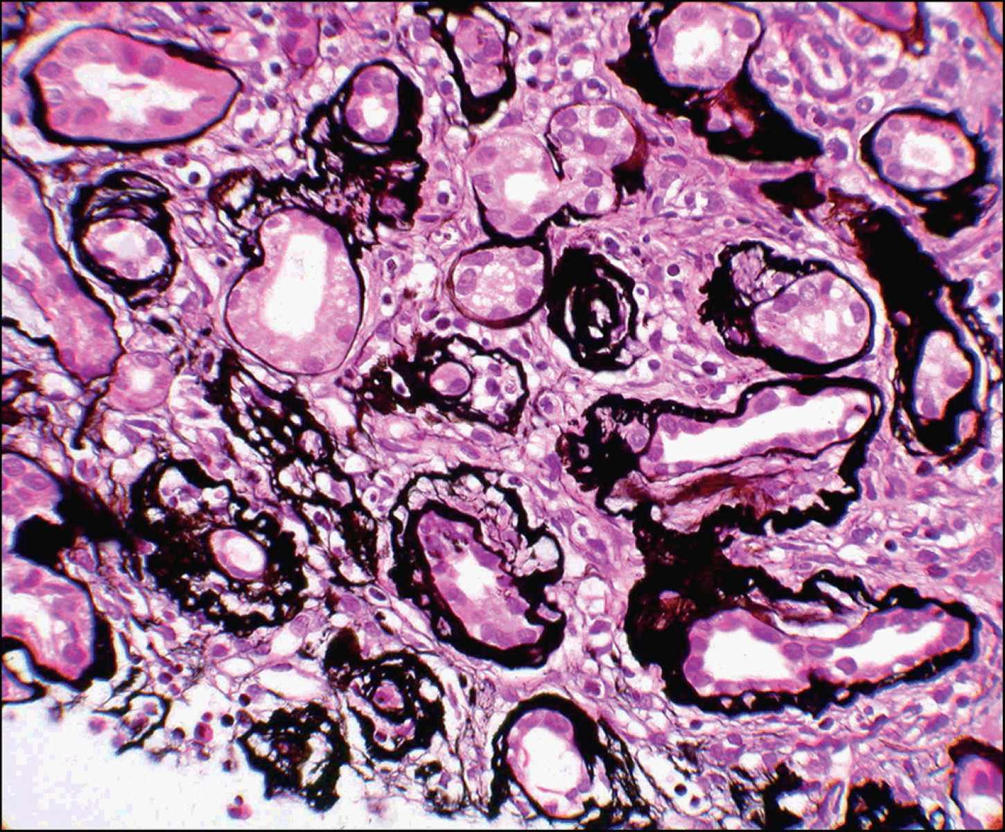 40-facts-about-juvenile-nephronophthisis