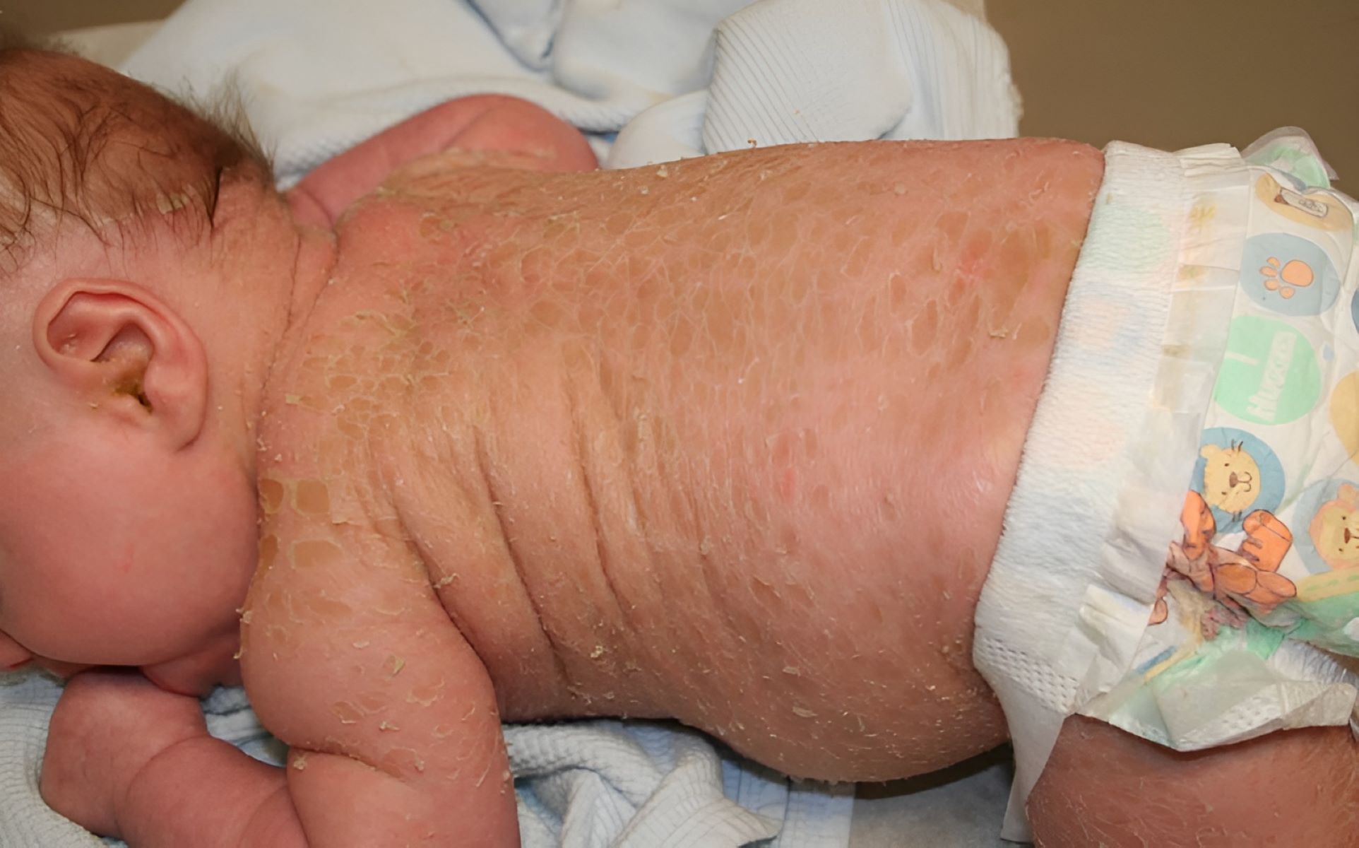 40-facts-about-lamellar-ichthyosis