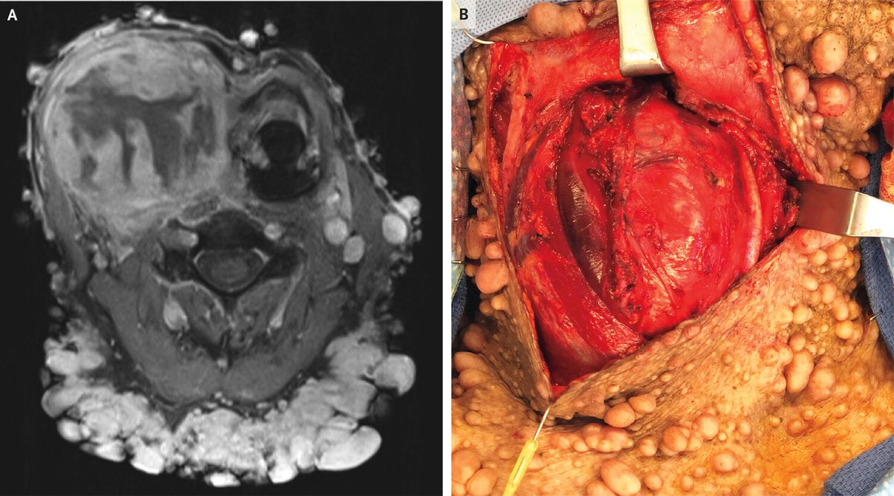 40-facts-about-malignant-peripheral-nerve-sheath-tumor