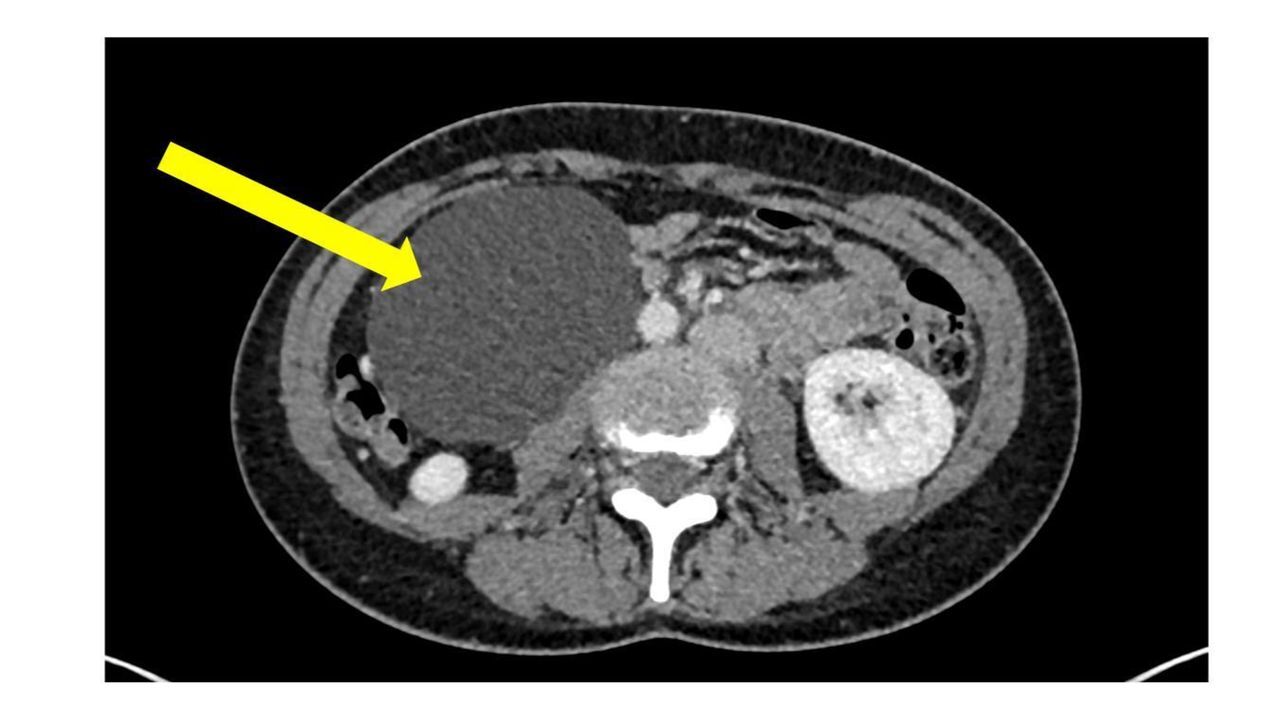 40-facts-about-mesenteric-cyst