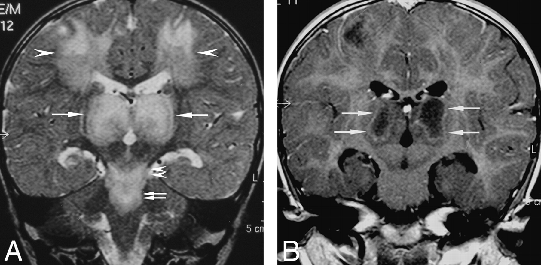 40-facts-about-necrotizing-encephalopathy