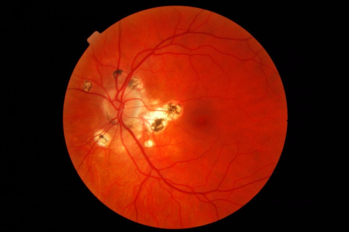 40-facts-about-ocular-histoplasmosis