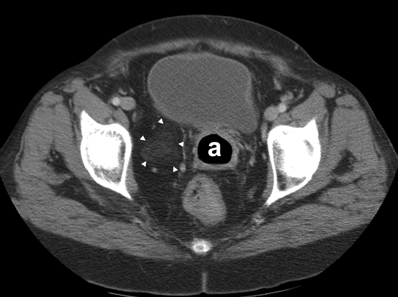 40-facts-about-pelvic-lipomatosis