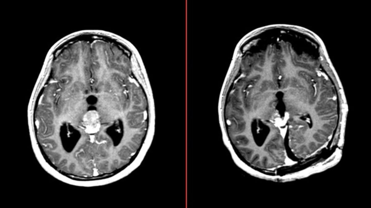 40-facts-about-pineoblastoma