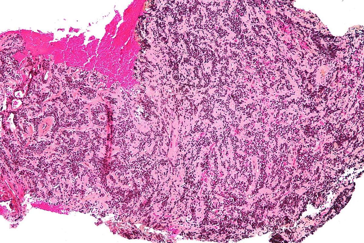 40-facts-about-pineocytoma