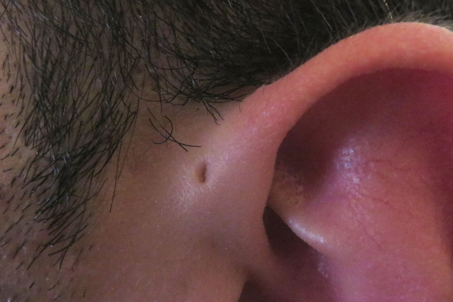 40-facts-about-preauricular-sinus-and-cyst