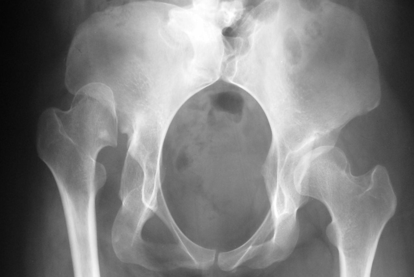 40-facts-about-sacral-agenesis