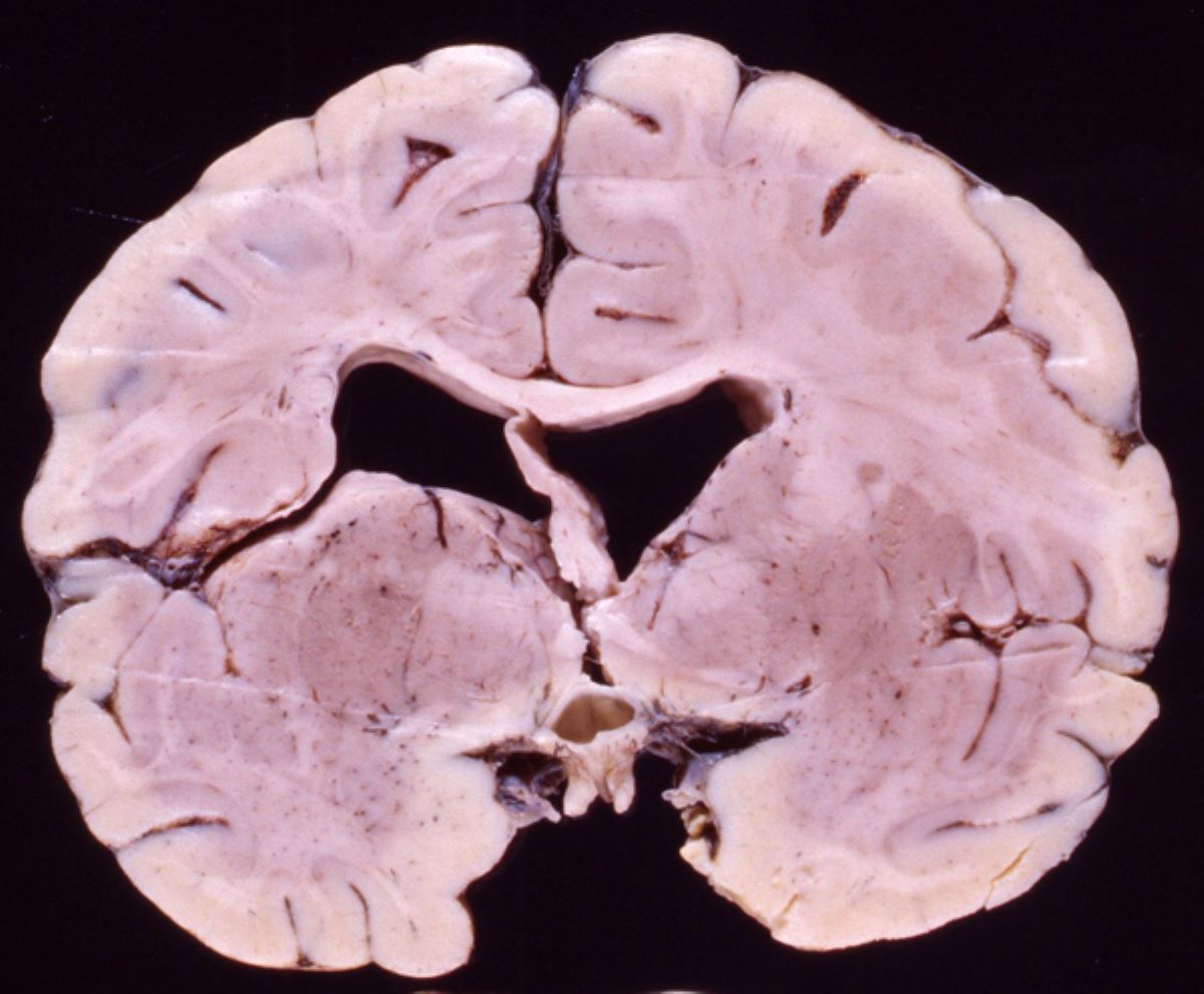 40-facts-about-schizencephaly