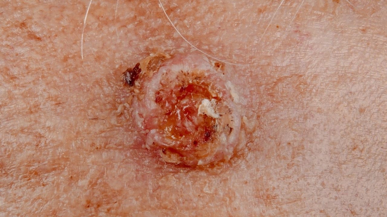 40-facts-about-squamous-cell-carcinoma-of-the-skin