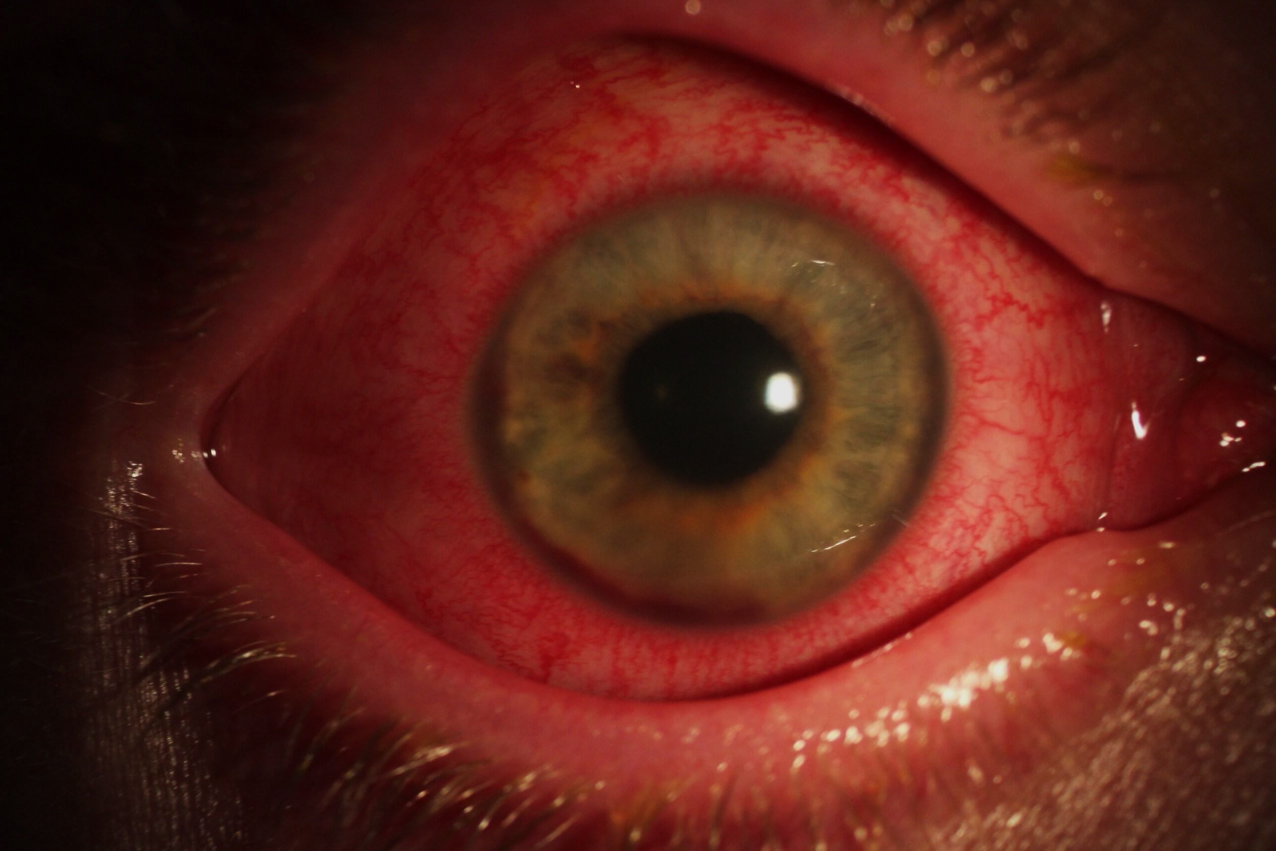 40-facts-about-toxic-conjunctivitis