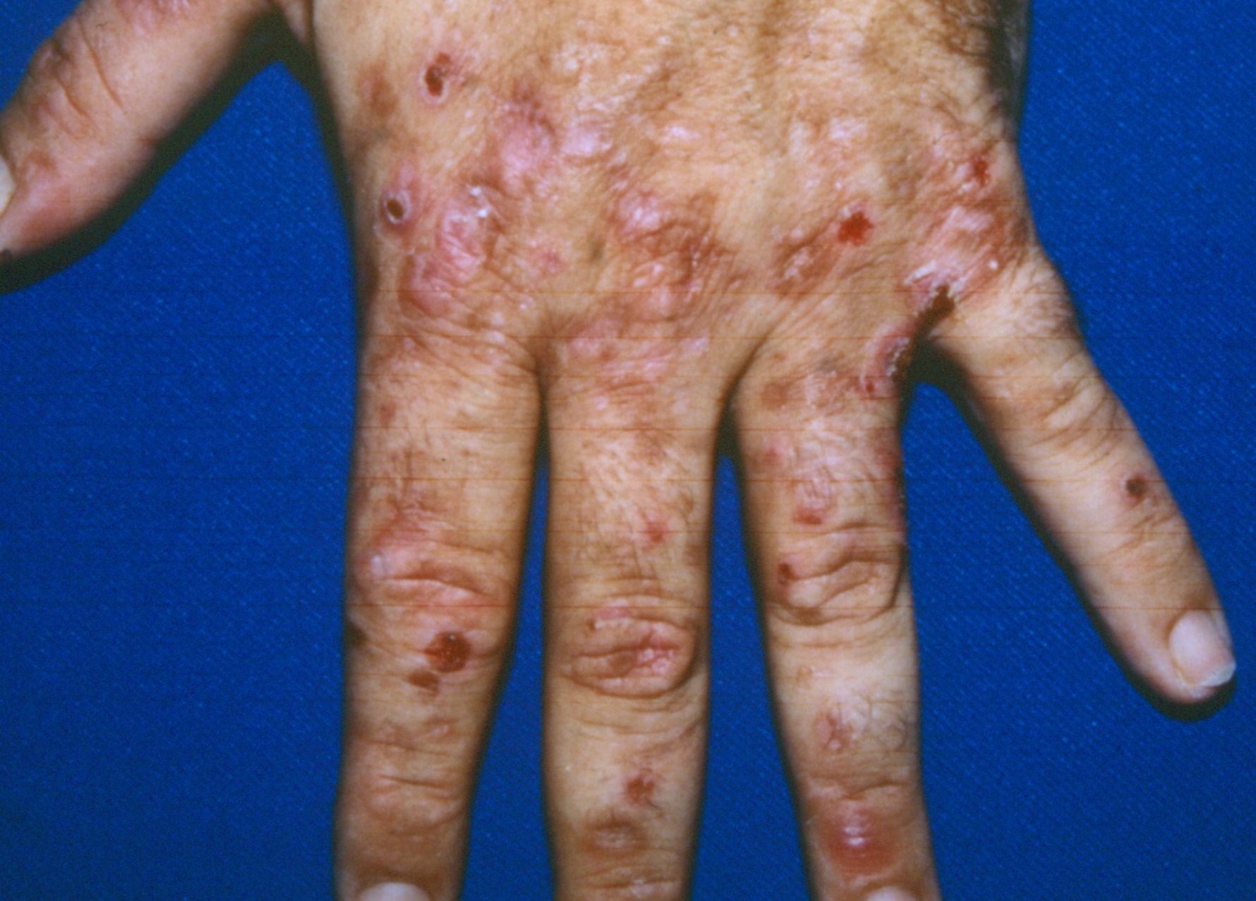 40-facts-about-variegate-porphyria