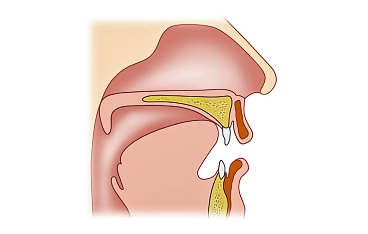 40-facts-about-velopharyngeal-incompetence