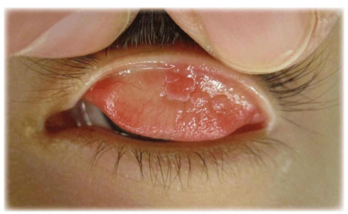 40-facts-about-vernal-keratoconjunctivitis