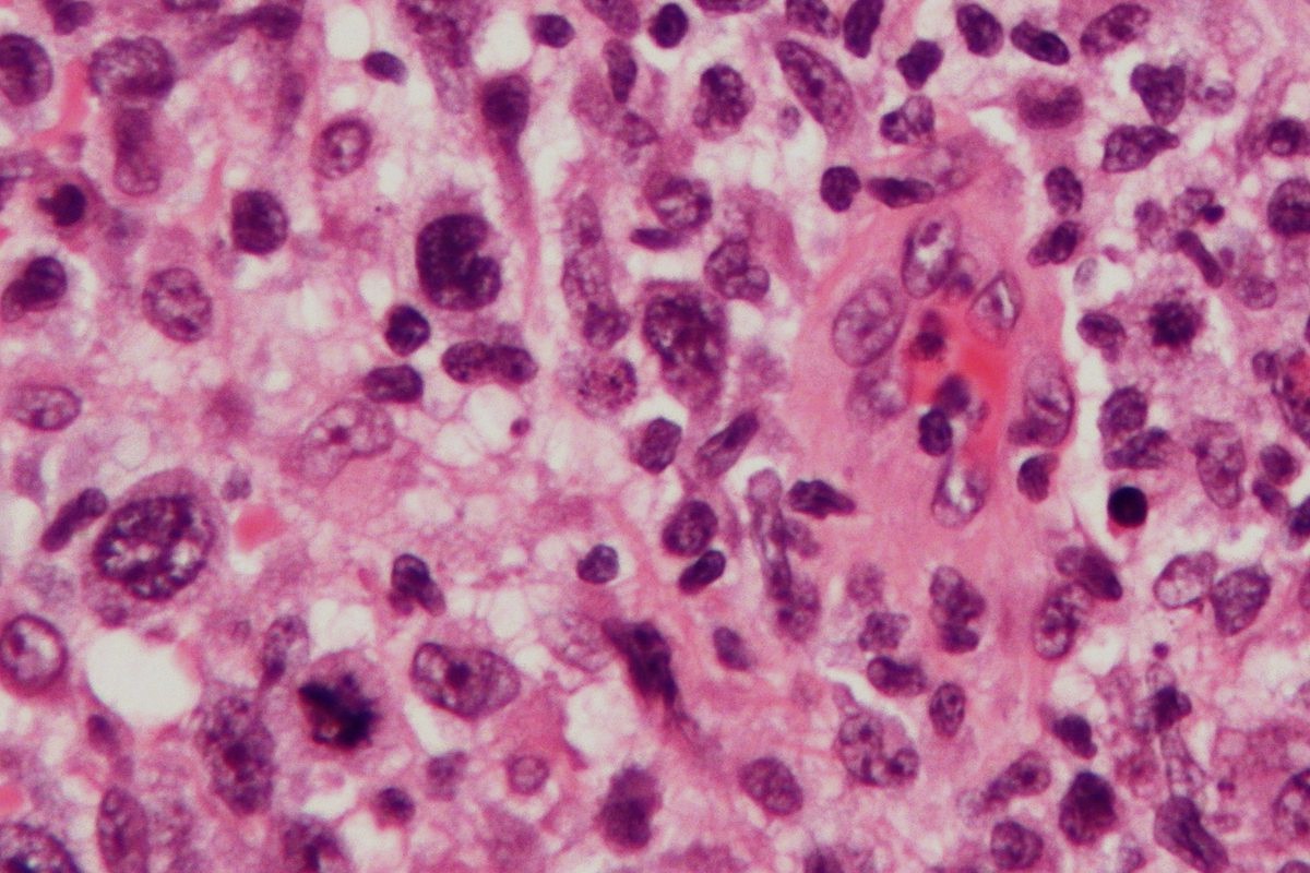 50-facts-about-anaplastic-large-cell-lymphoma