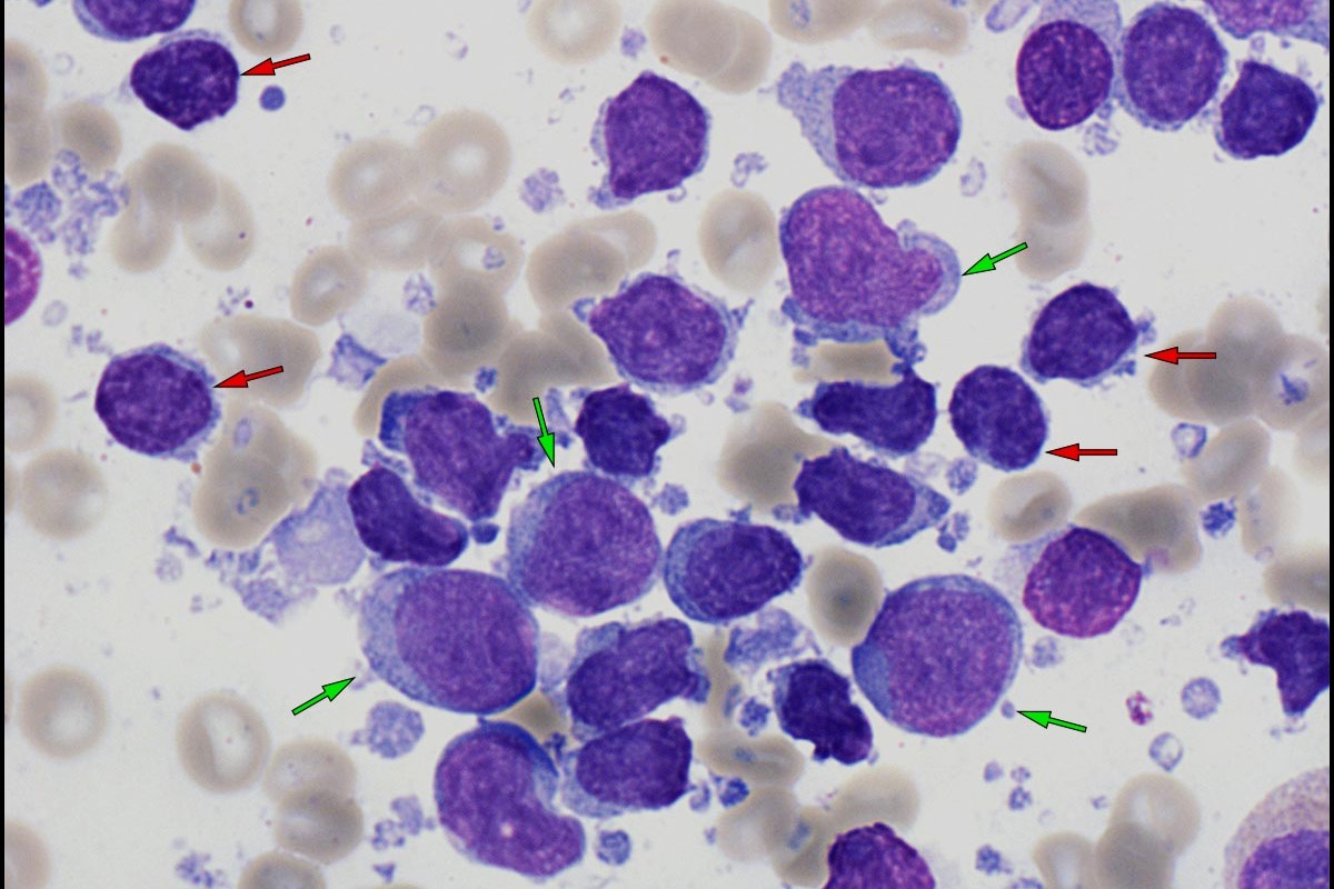 50-facts-about-diffuse-large-b-cell-lymphoma