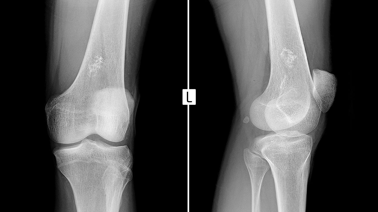 50-facts-about-ewings-sarcoma