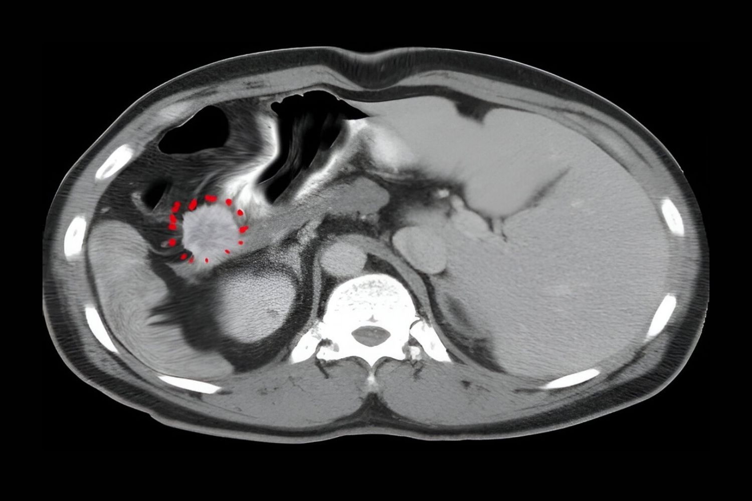 50-facts-about-gastrinoma