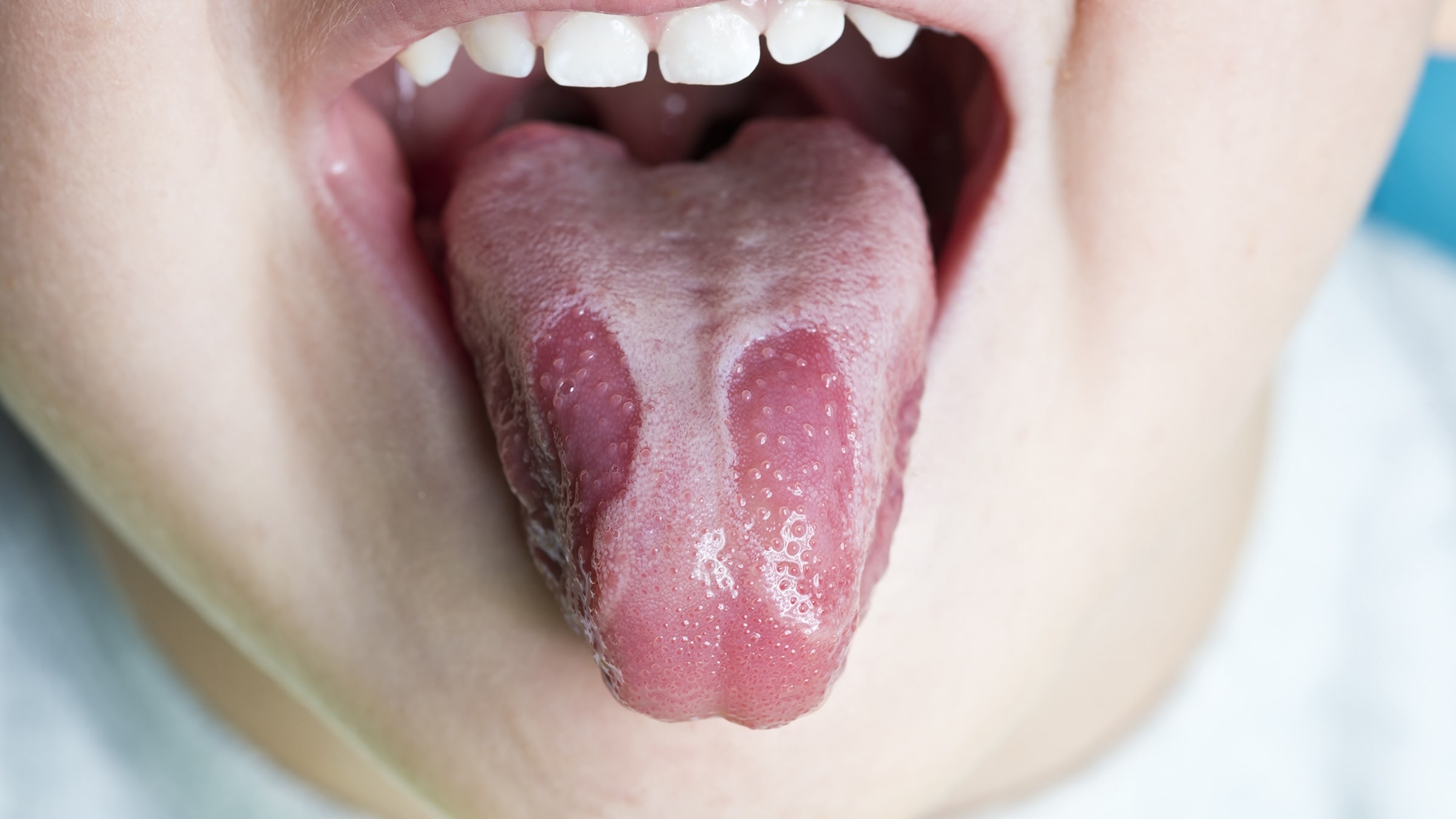 50-facts-about-geographic-tongue