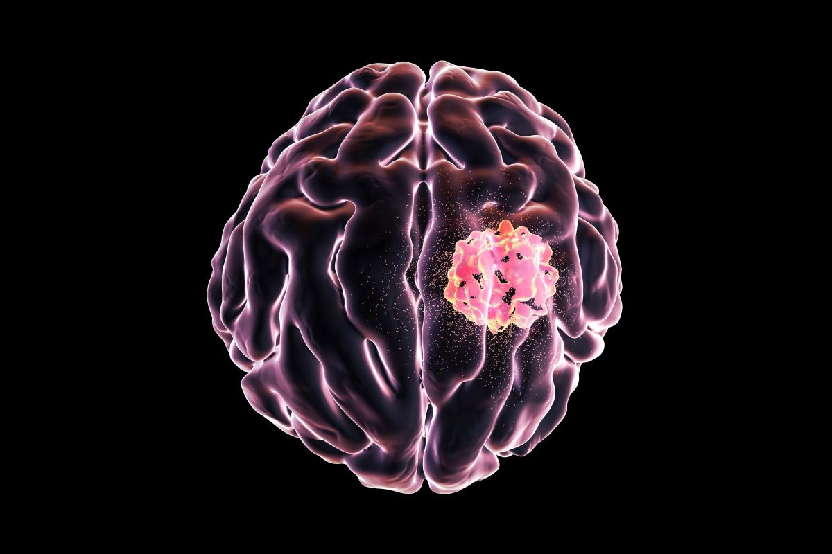 50 Facts About Glioma - Facts.net