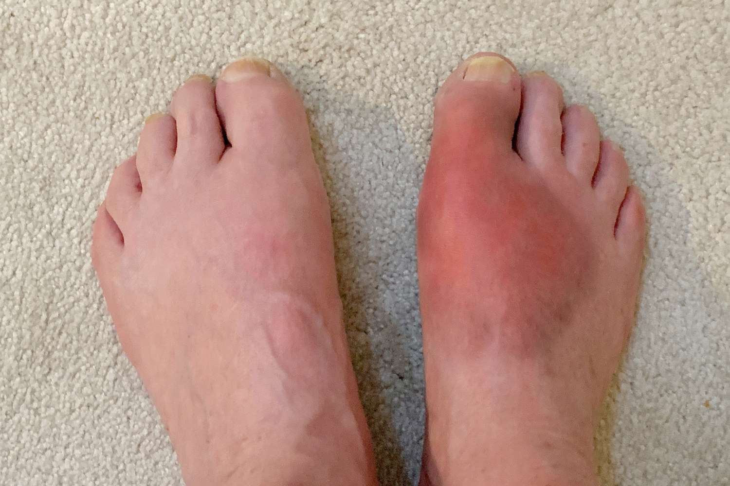 50-facts-about-gout