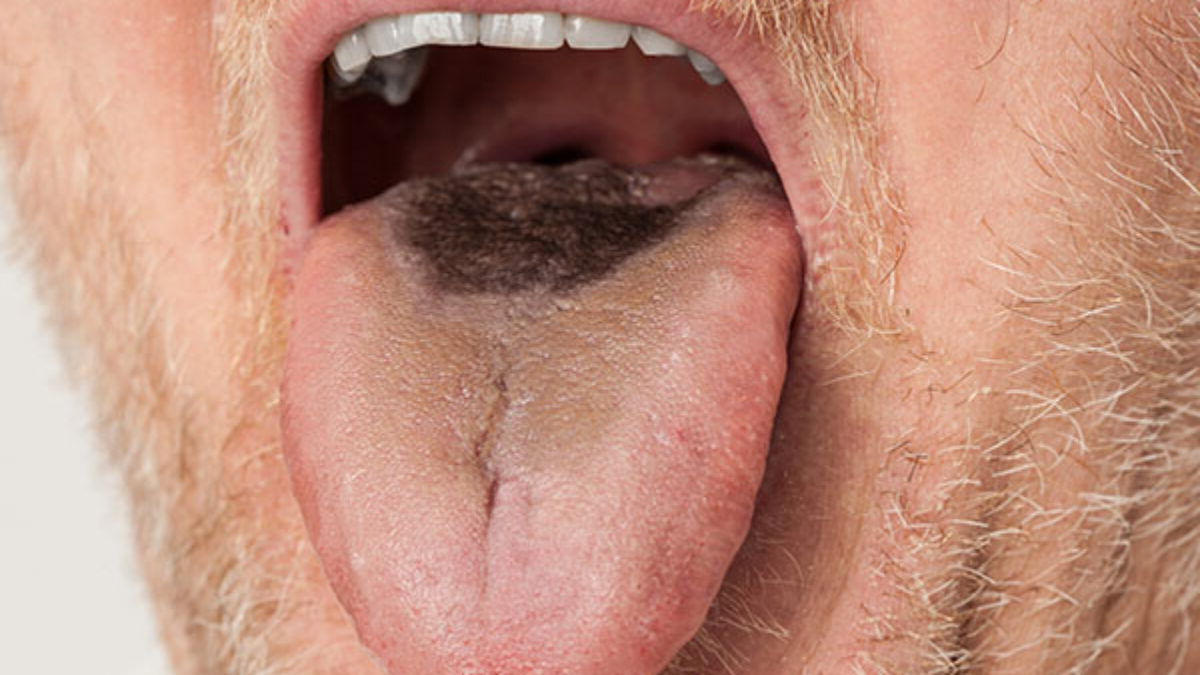 50-facts-about-hairy-tongue