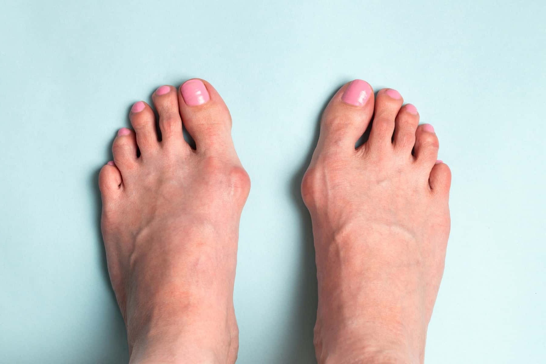 50-facts-about-hallux-valgus