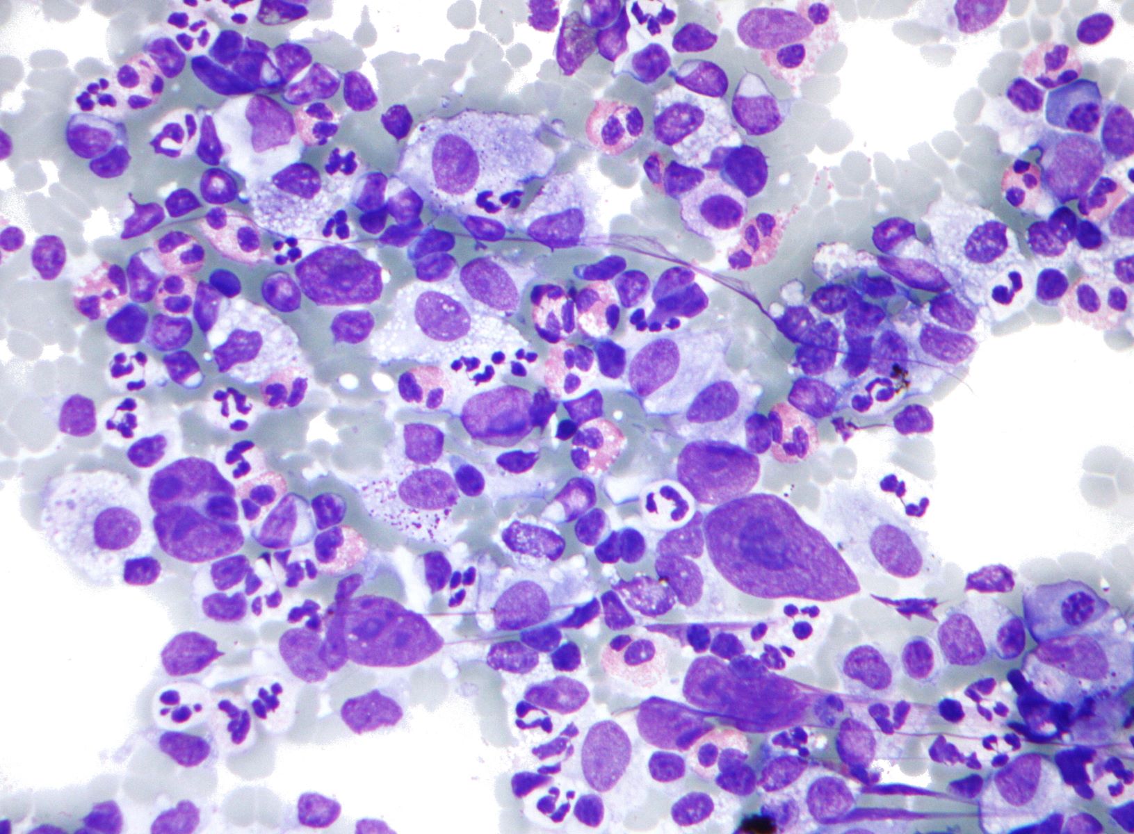 50-facts-about-hodgkin-lymphoma