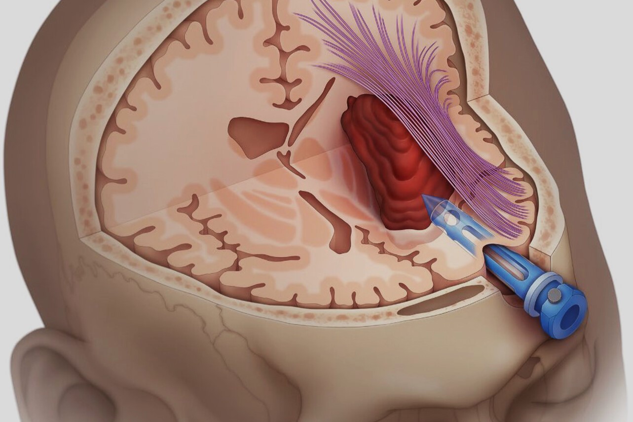 50-facts-about-intracranial-hemorrhage