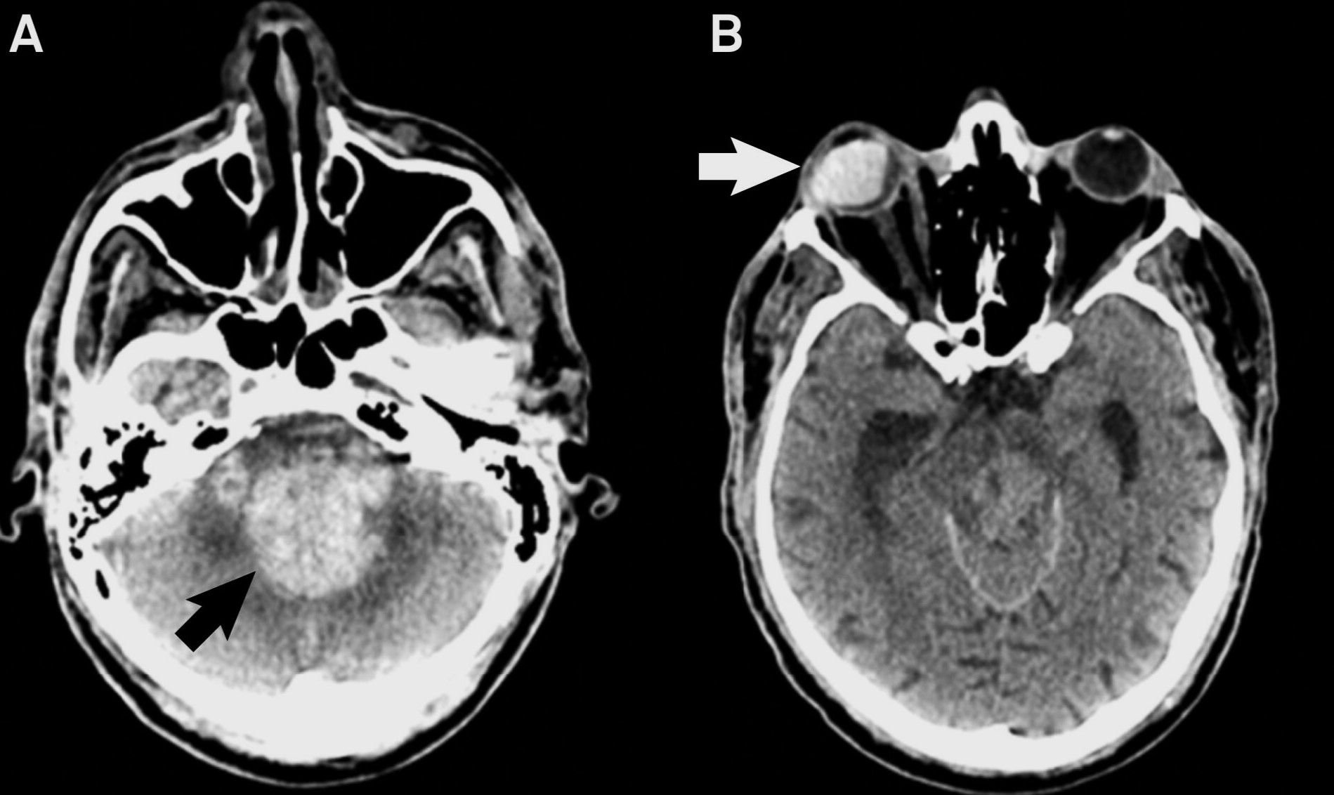 50-facts-about-intraparenchymal-hemorrhage