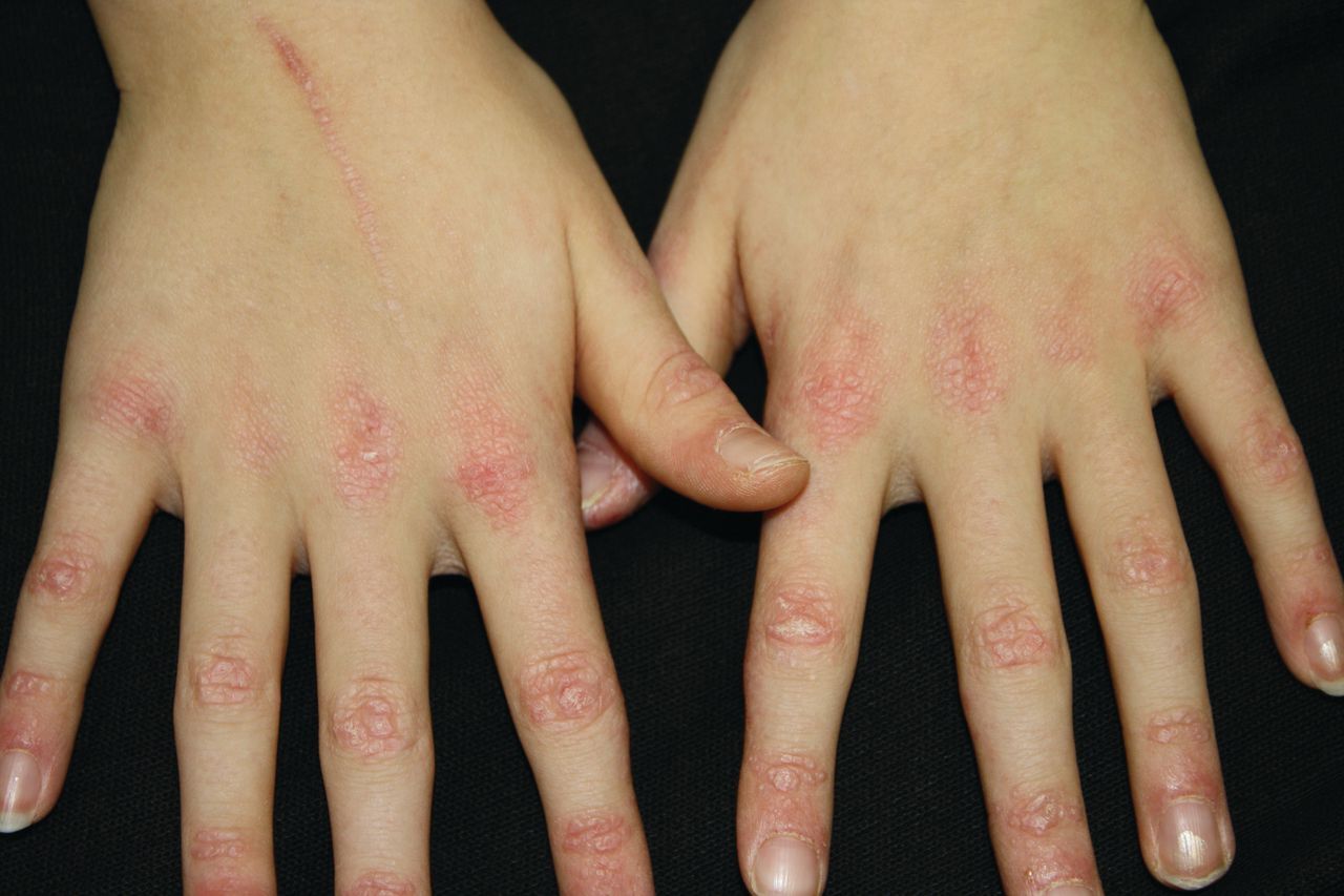 50-facts-about-juvenile-dermatomyositis