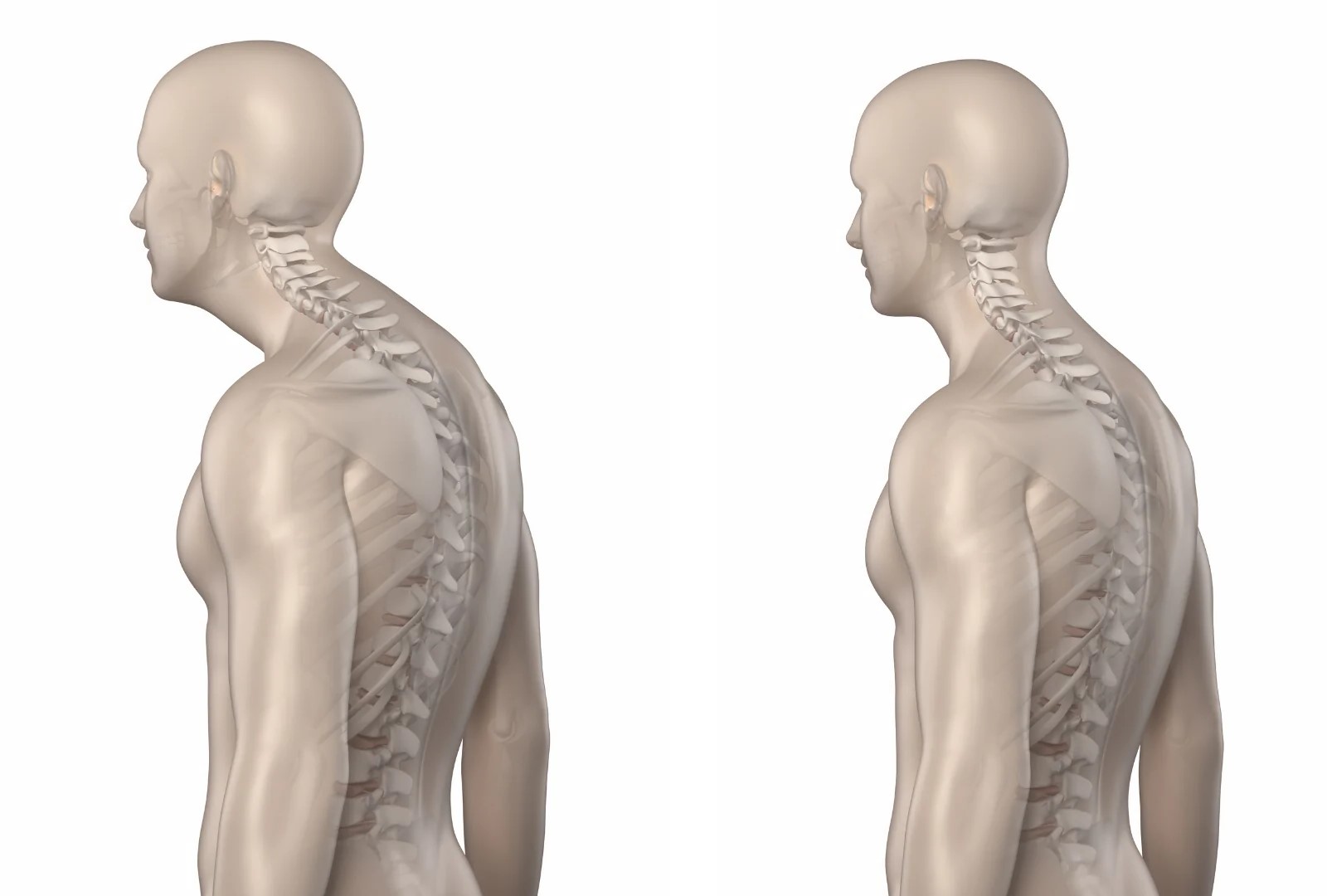 50-facts-about-kyphosis