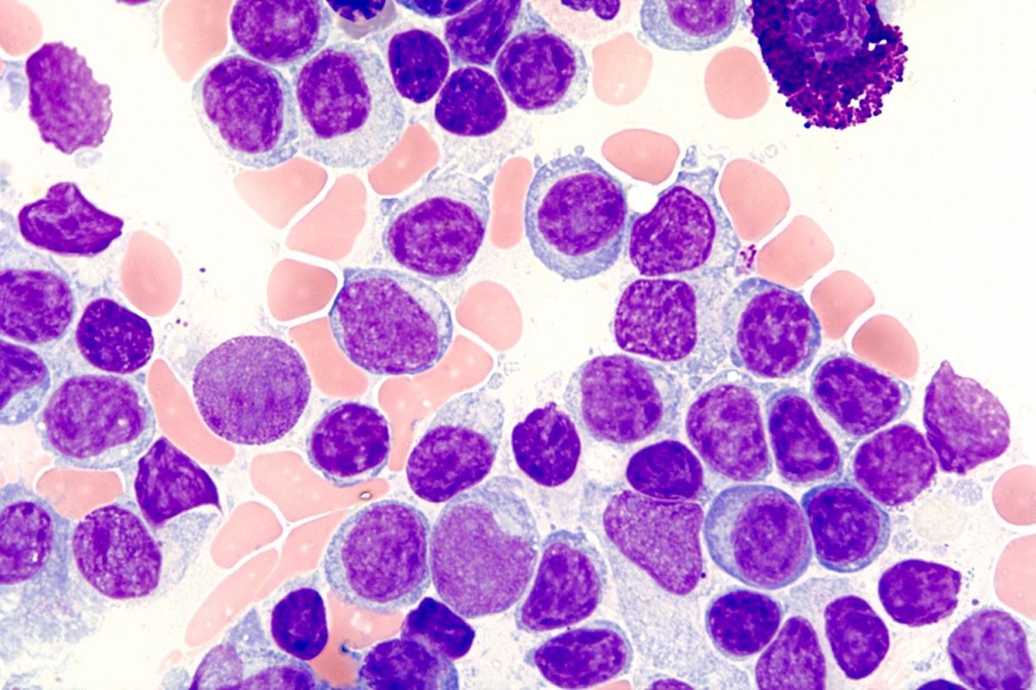 50-facts-about-lymphoplasmacytic-lymphoma