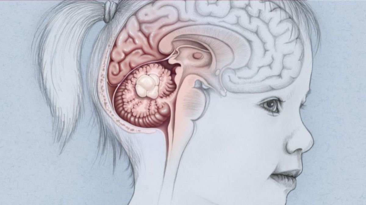 50-facts-about-medulloblastoma