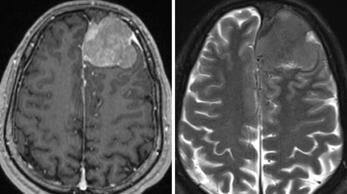 50-facts-about-meningioma