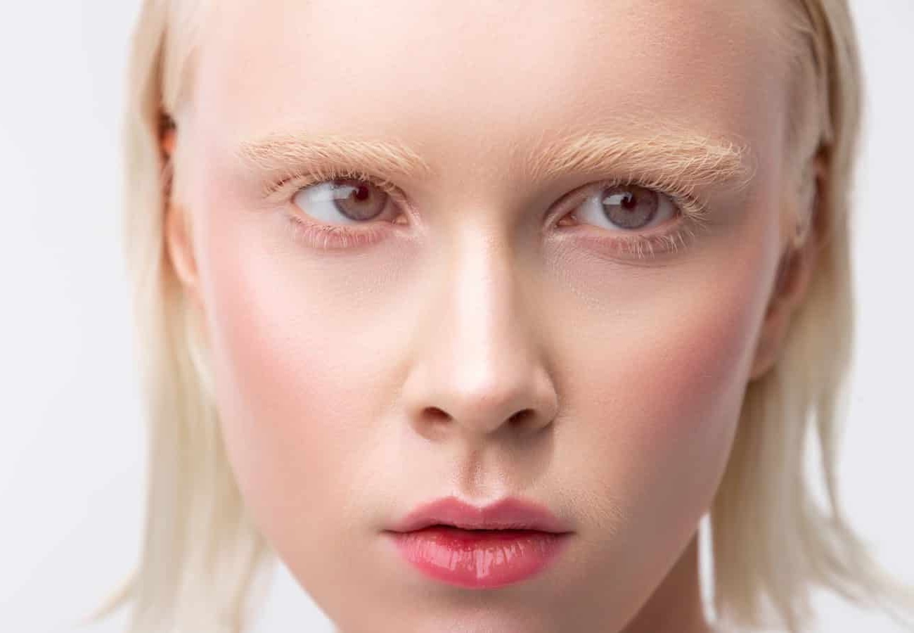 50-facts-about-ocular-albinism