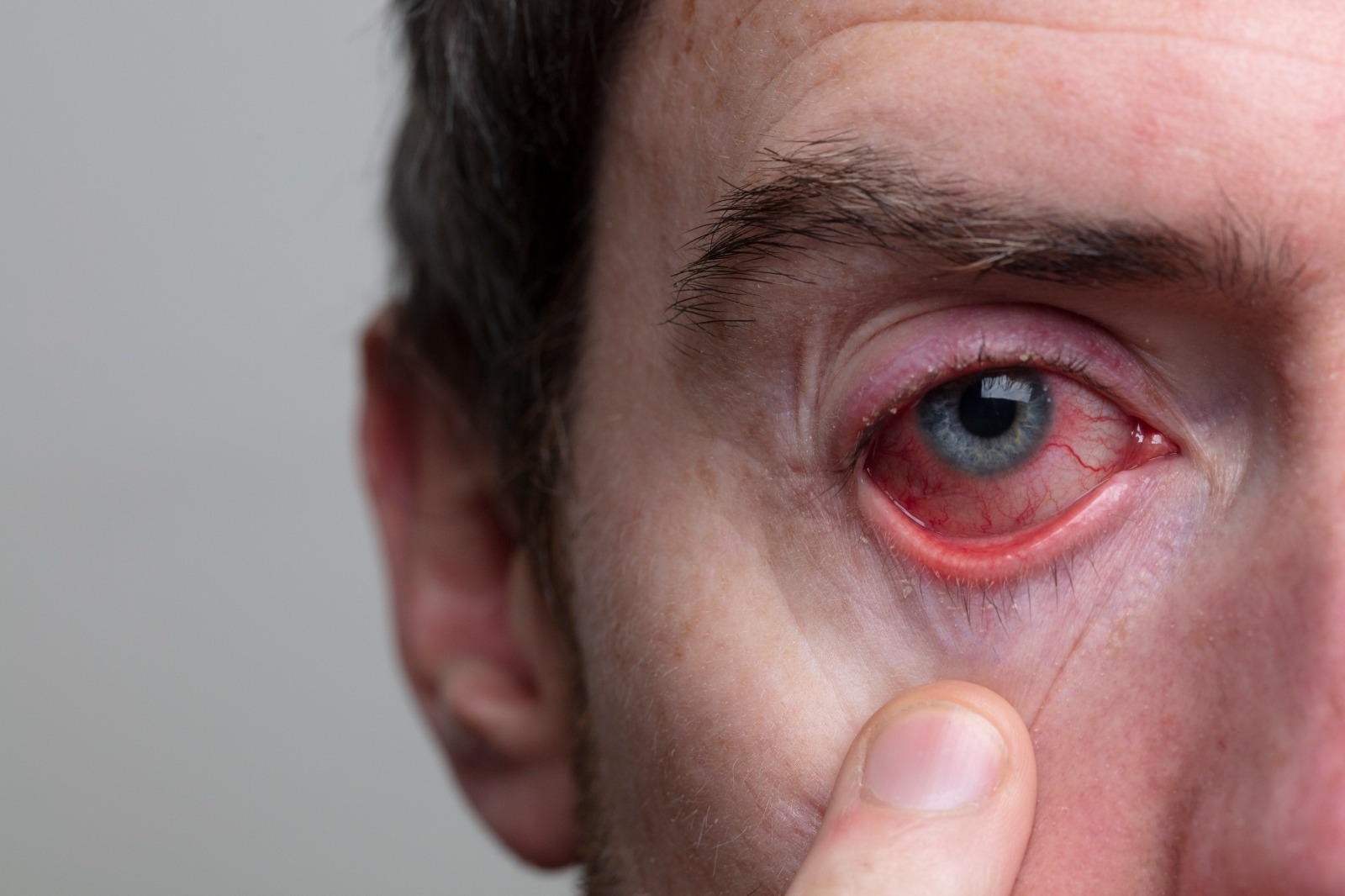 50-facts-about-ocular-melanoma