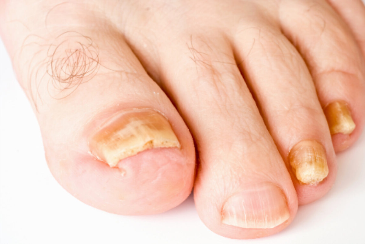 50-facts-about-onychomycosis