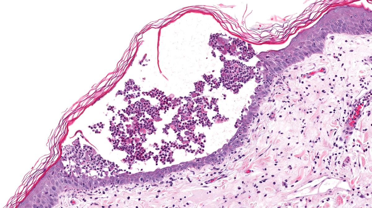 50-facts-about-pemphigus