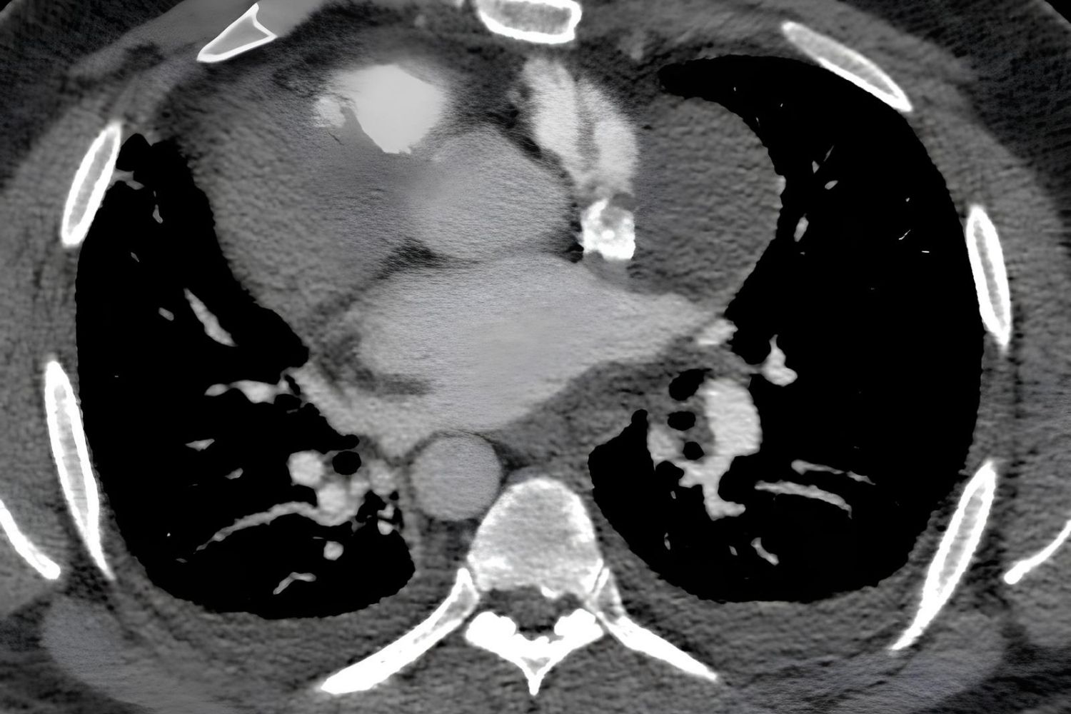 50-facts-about-pericardial-cyst