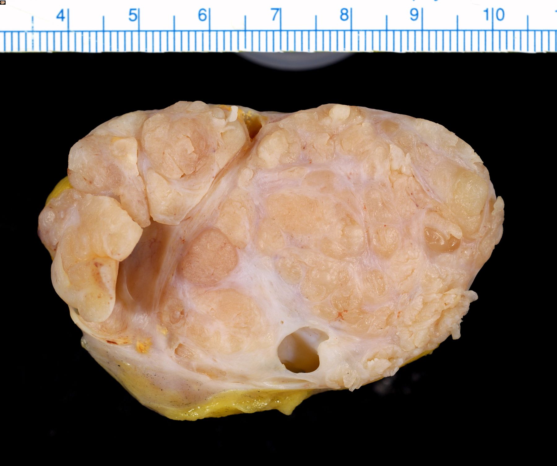 50-facts-about-phyllodes-tumor