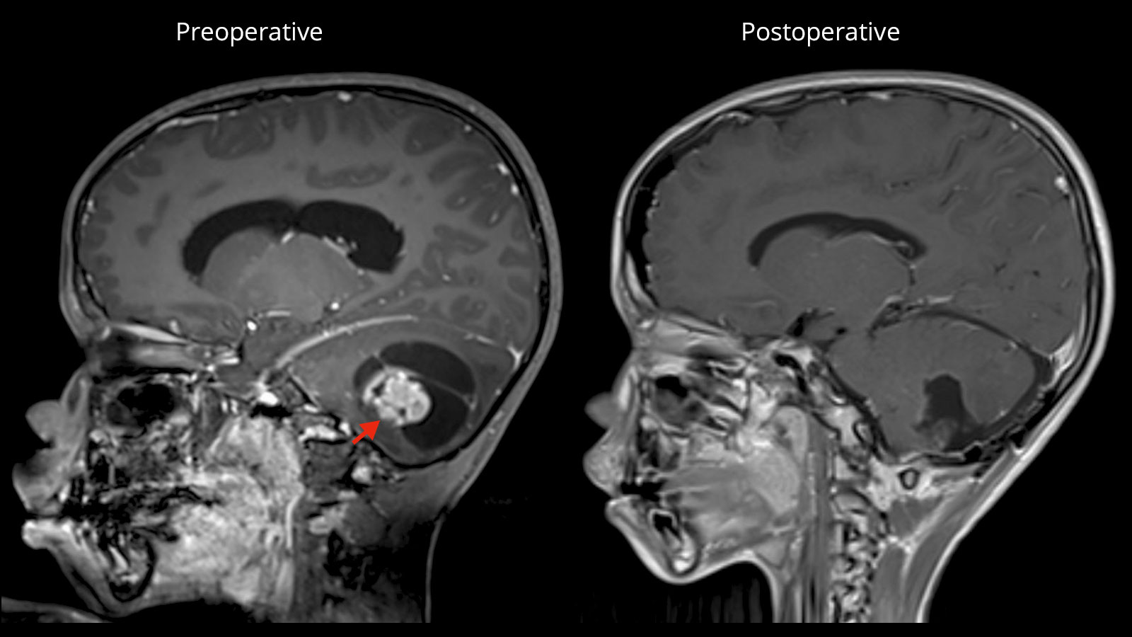 50-facts-about-pilocytic-astrocytoma