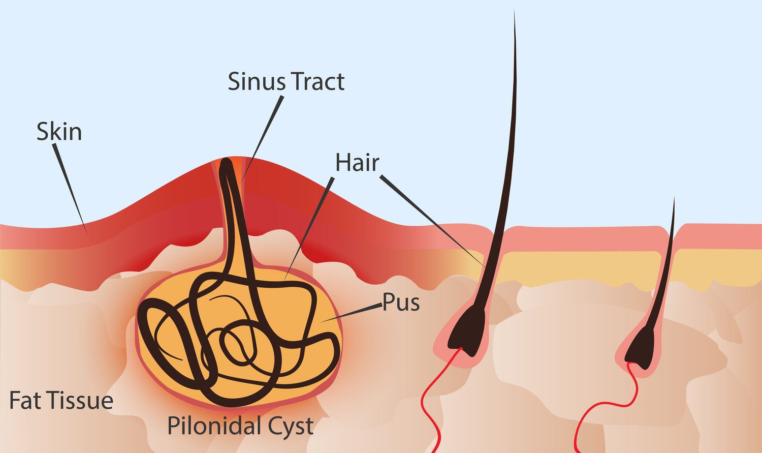 50-facts-about-pilonidal-cyst