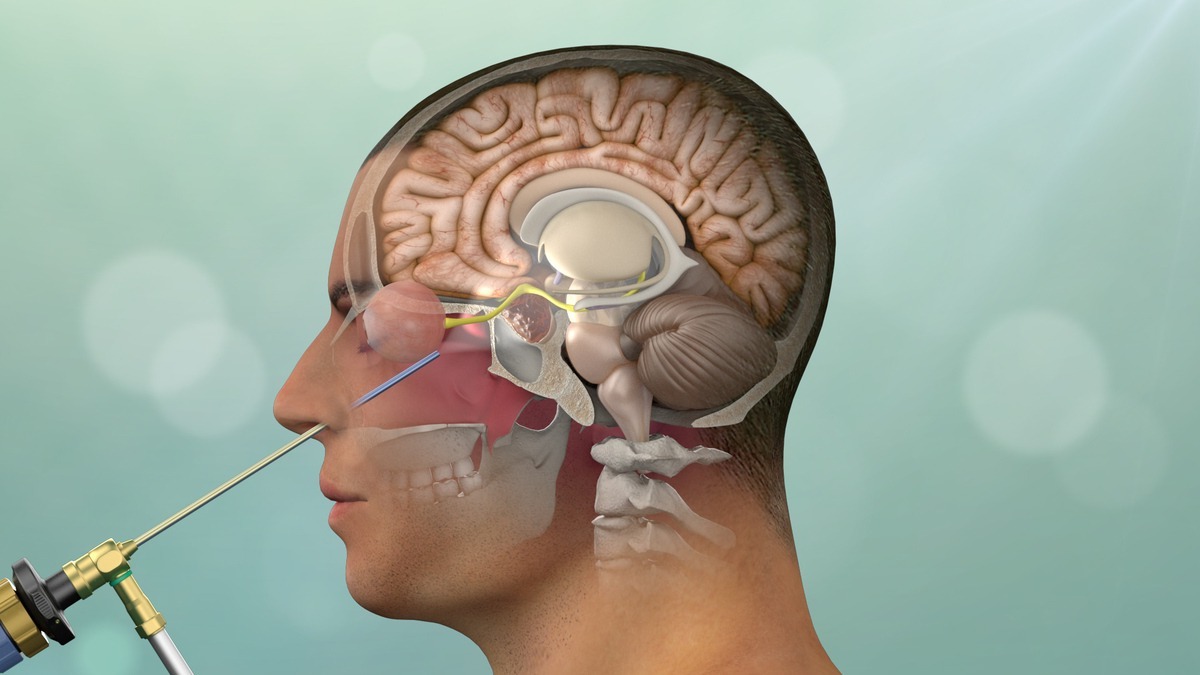 50-facts-about-pituitary-adenoma