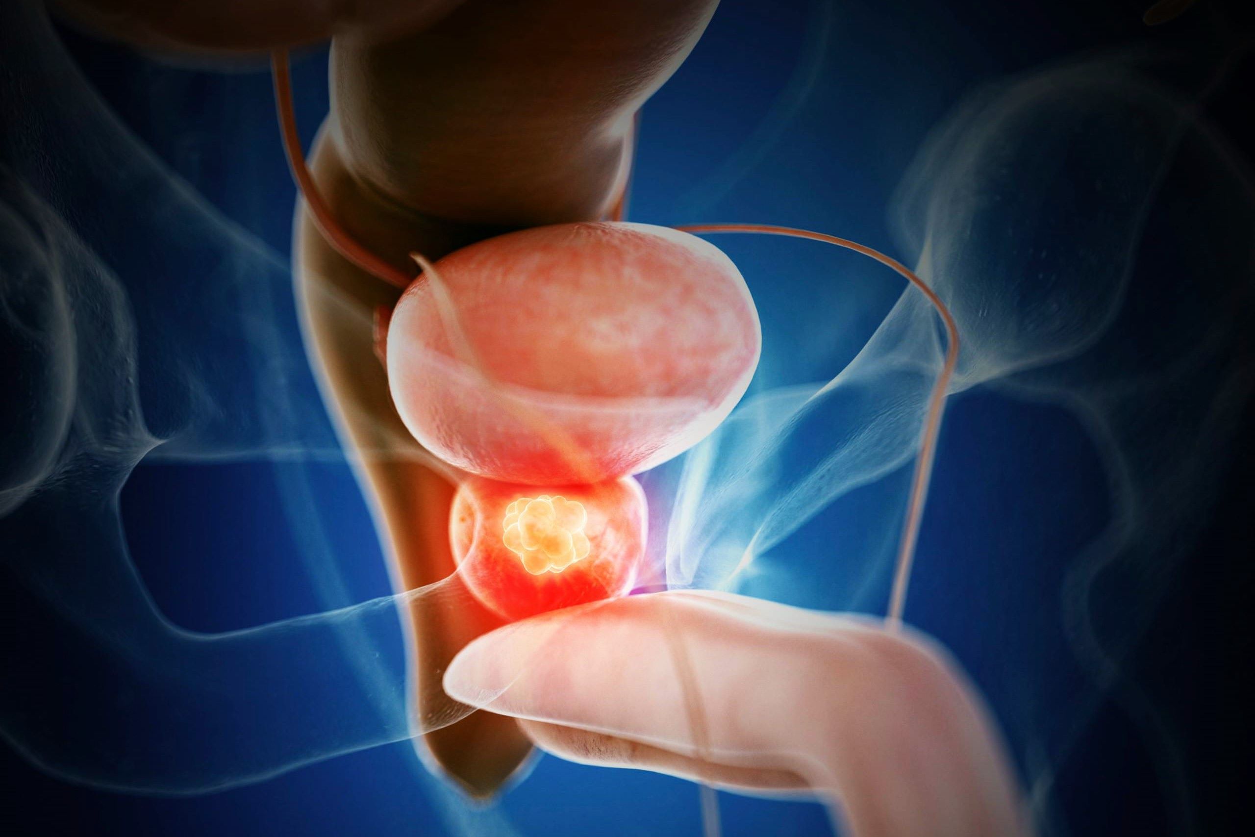 50-facts-about-prostate-cancer