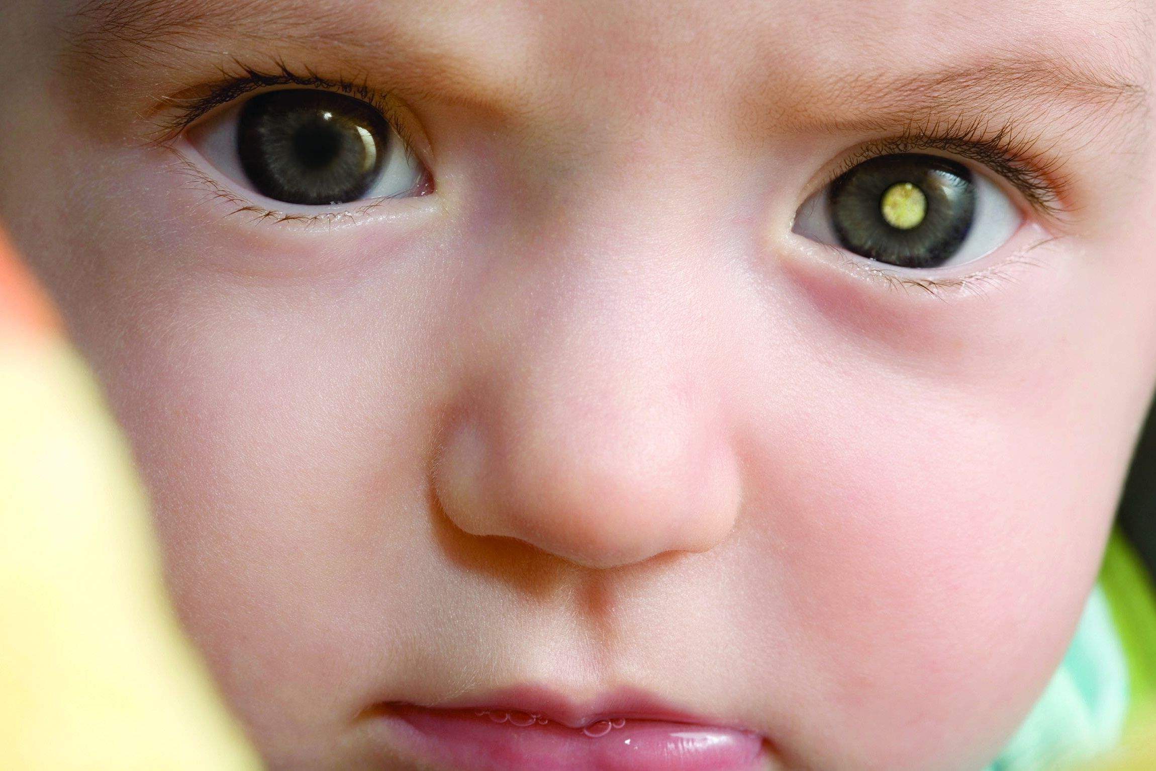 50-facts-about-retinoblastoma