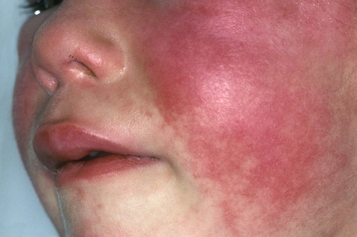 50-facts-about-scarlet-fever