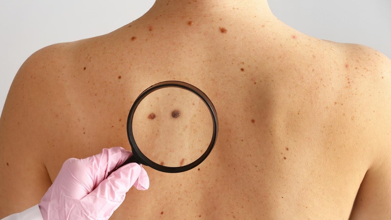 50-facts-about-skin-cancer