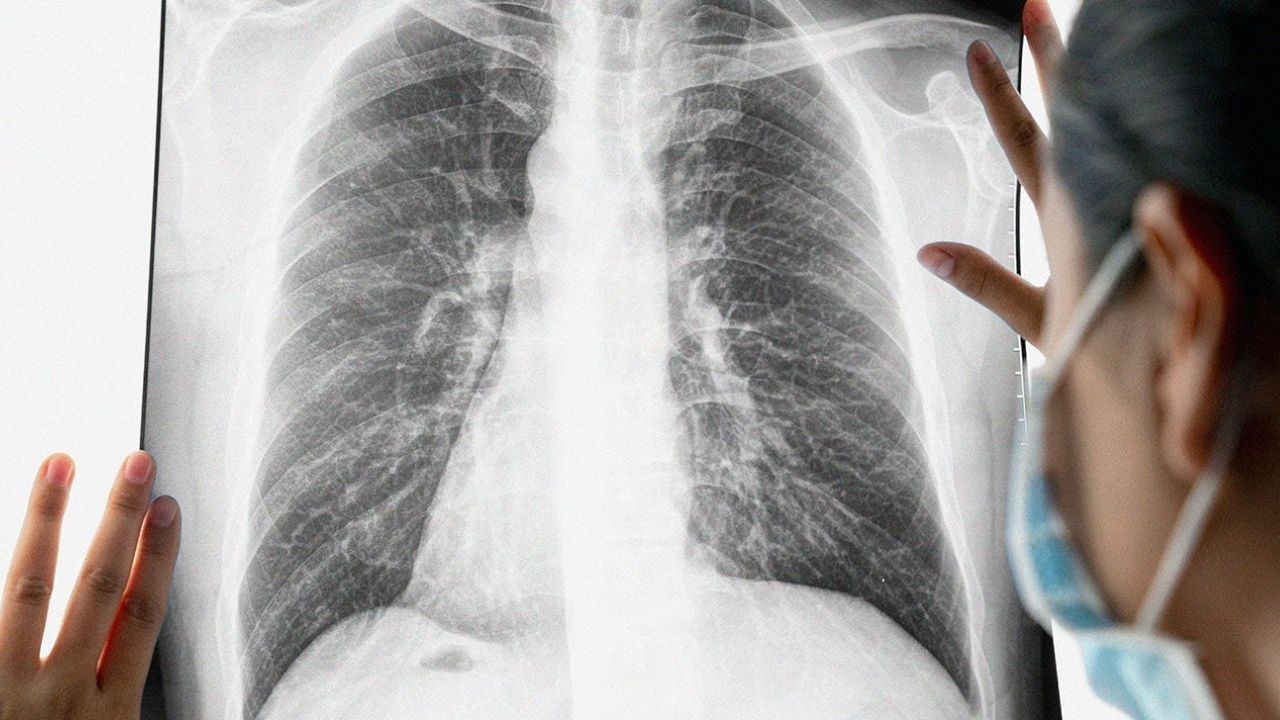 50-facts-about-small-cell-lung-cancer