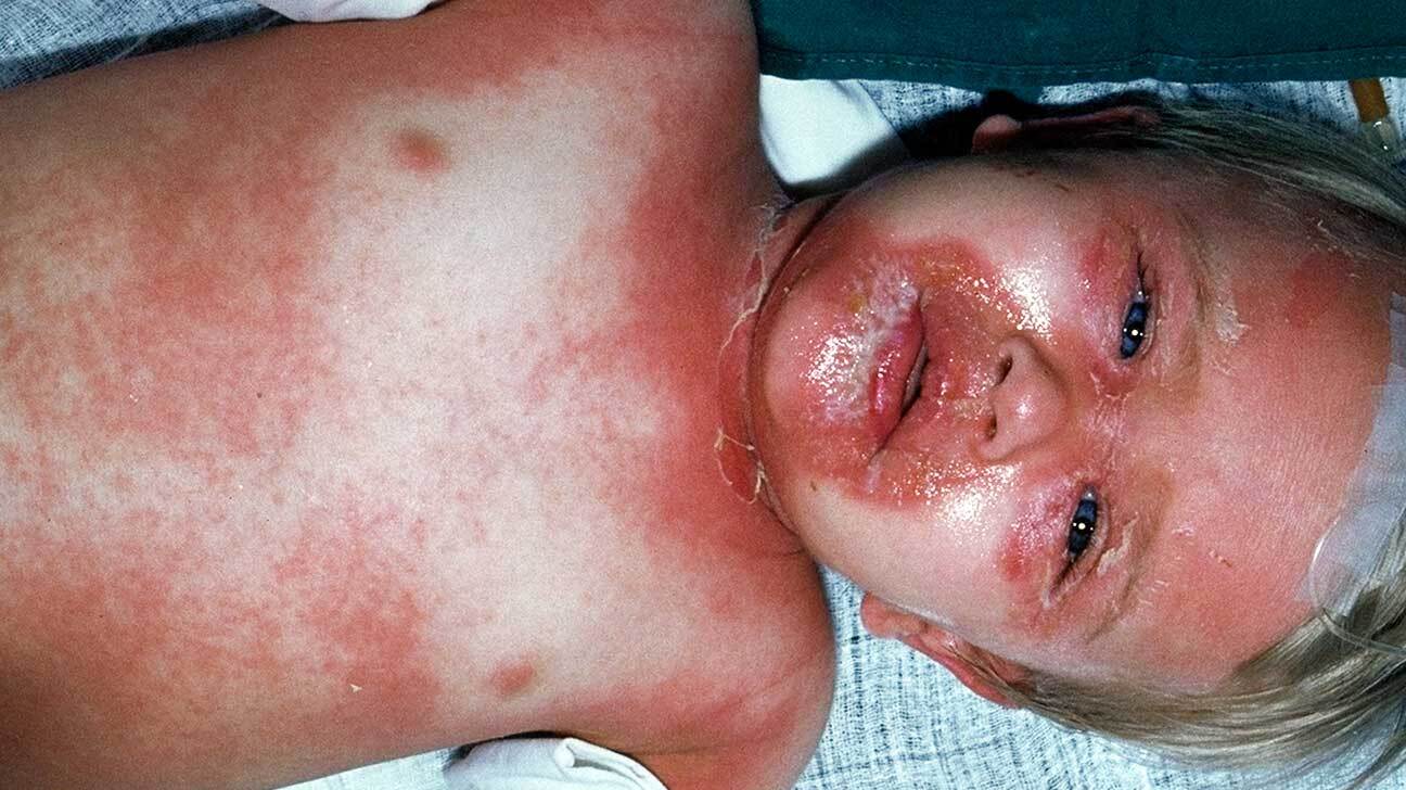 50-facts-about-staphylococcal-scalded-skin-syndrome